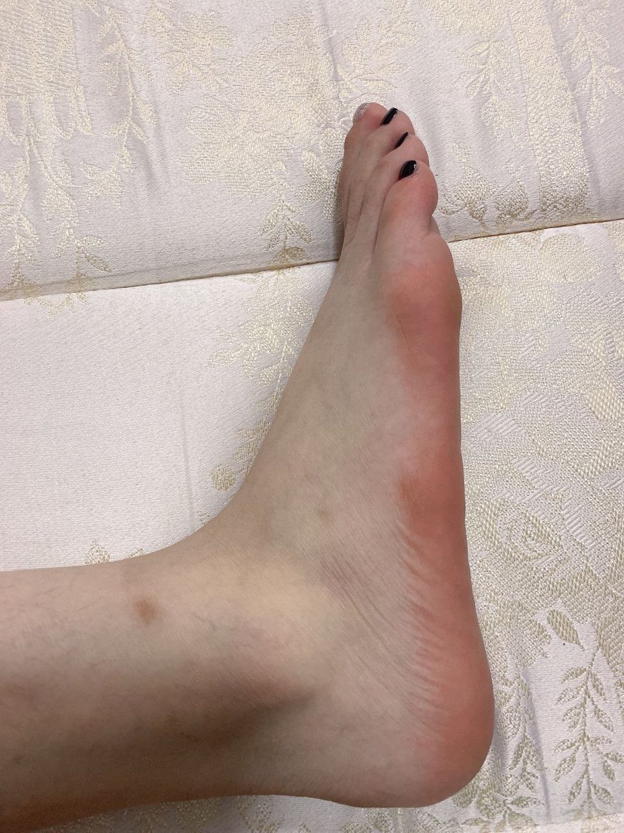 baoyuhezi8's tweet photo. 嫩白玉足赤裸踩在锦缎床单上，五趾修长，黑漆甲面闪着淫光，唯一那颗银粉趾尖像骚穴般刺眼，脚背青筋隐现，脚心粉嫩湿润，仿佛随时要被舔到发抖。

#足控 | #套路脚拍 | #恋足 | #大学生
    
7P . 1V

点击主页链接查看更多精彩资源 https://t.co/psQrzvYaEK