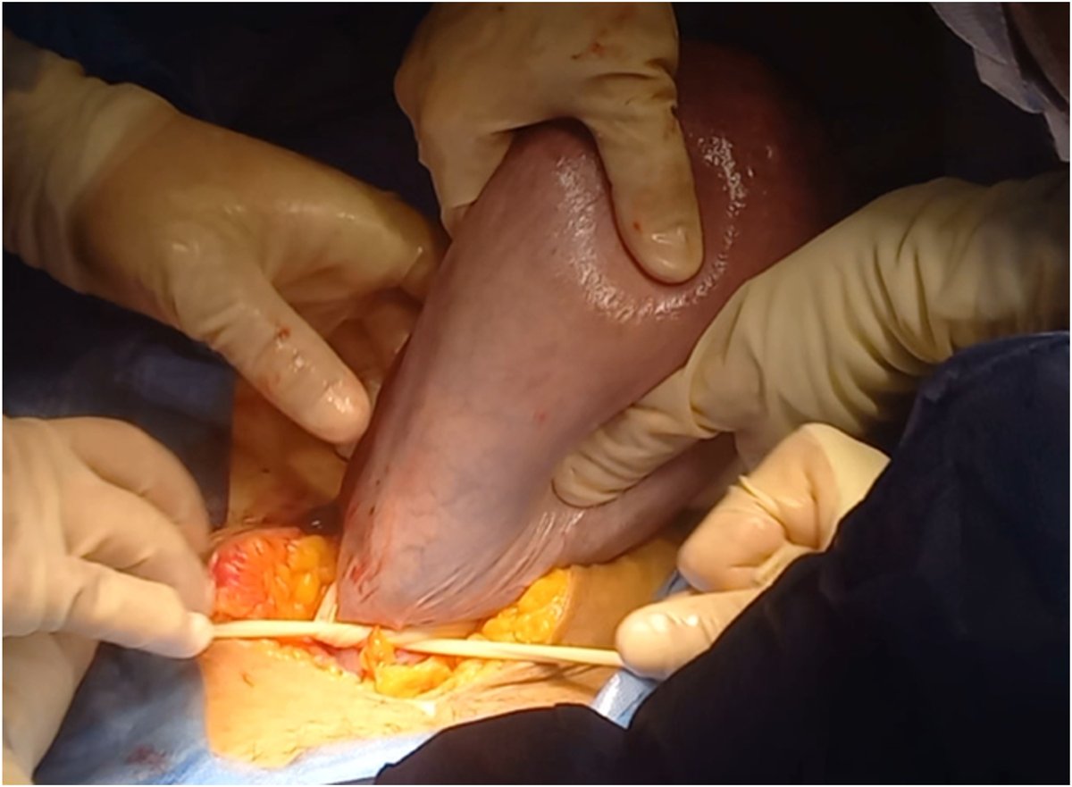 AJOG_thegray's tweet photo. AJOG Expert Review in Cesarean: Uterine tourniquet
A Penrose drain has been placed at the uterine isthmus and tied securely to reduce perfusion from the uterine arteries. https://t.co/q2VPpTQW9M https://t.co/God9IbxqeX