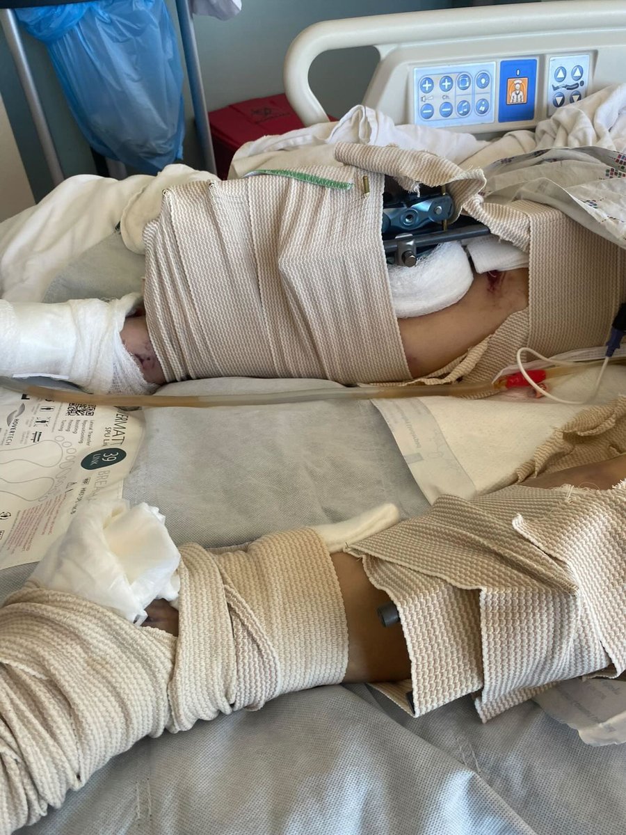 henrykleeKTVU's tweet photo. Woman, 20, falls out of boyfriend’s Ford Mustang as he spins donuts on Fourth of July before he runs her over - and takes off, per @VallejoPd. She’s fighting for her life, @AmberKTVU reports. Boyfriend, 20, later arrested but now out of custody pending #SolanoDA review https://t.co/33p3YewXz5