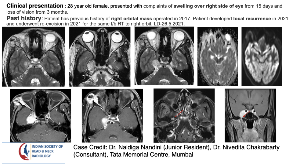 teamishnr's tweet photo. #caseoftheweekanswer
Please find the answer
#radiology #caseoftheweek #headandneck #radiologycases #dailywork #ISHNR #teaching #research #imaging #FOAM #FOAMRad #FOAMMed
Visit our website: https://t.co/bXxtVEvYZY
All Cases: https://t.co/0xaPvoBy5H https://t.co/DwBOBXYmv5