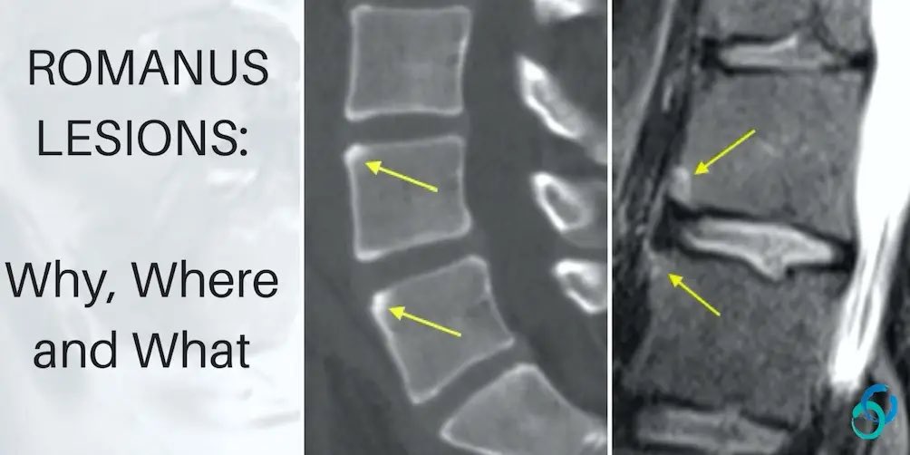 NY3080's tweet photo. @hemo_shk Romanus' sign (or the "shiny corner sign") is an early spinal finding in ankylosing spondylitis. It indicates active inflammation at the discovertebral junction, the area where intervertebral discs attach to the bone. https://t.co/2qG0ctY0ol