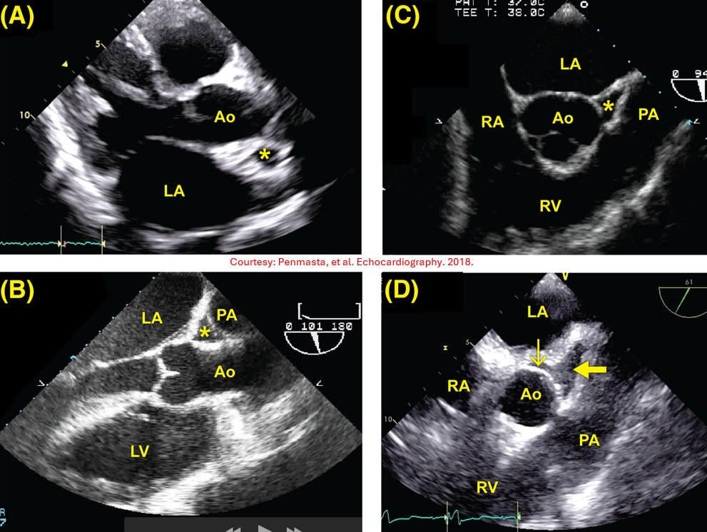 NephroP's tweet photo. 🫀#echoboards prep question
The asterisk in panels A-C and the arrow in panel D all indicate the same anatomic structure. What is it?
📌 Panel A is a transthoracic echocardiogram
📌 Panels B–D are transesophageal echocardiograms https://t.co/sewM3XaIOf