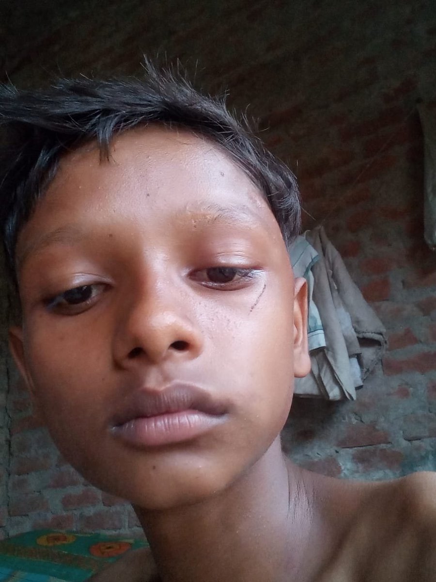 Rajeshwar11ASP's tweet photo. उत्तर प्रदेश के जनपद #प्रतापगढ़ थाना कुंडा के अंतर्गत ग्राम आमामऊ में बकरी चराने गया 12 वर्ष #दलित बच्चे को बेरहमी से गांव के पप्पू सिंह द्वार मारा पीटा गया @Uppolice @CMOfficeUP @ADGZonPrayagraj @pratapgarhpol प्रकरण की गंभीरता को देखते हुए तत्काल प्रभाव से कानूनी कार्यवाही करे https://t.co/xWIwDHQ5Cu