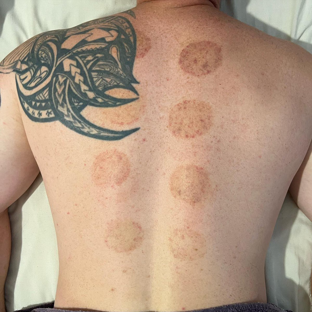 RebeccaTalbot01's tweet photo. DRY CUPPING
As you can see in the first photo (immediately after removing cups) visible marks are left on the skin - this is completely normal. We are increasing blood flow to the area just as we do when we massage with our hands.
The second image is 24 hours after treatmen. https://t.co/LO2IPmVpgo