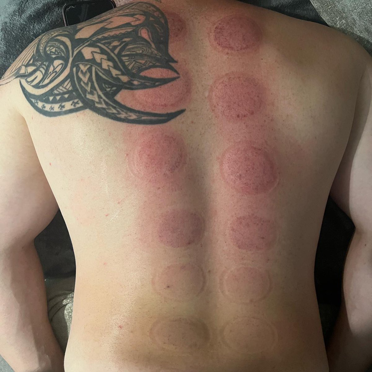 RebeccaTalbot01's tweet photo. DRY CUPPING
As you can see in the first photo (immediately after removing cups) visible marks are left on the skin - this is completely normal. We are increasing blood flow to the area just as we do when we massage with our hands.
The second image is 24 hours after treatmen. https://t.co/LO2IPmVpgo