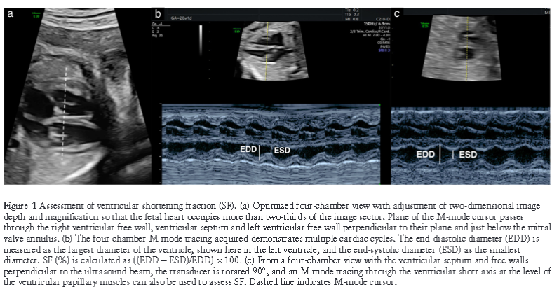 doctorneyro's tweet photo. Assessment #fetalventricularfunction is intgral com-ponent of #fetalcardiacevaluation
Although #qualitative assessment is sufficient for most routine #fetalechocardiograms, fetuses at #risk for #ventriculardysfunction should go #quantitative @ventricular
https://t.co/WvHKaKVqlI https://t.co/w2G2R3DozU