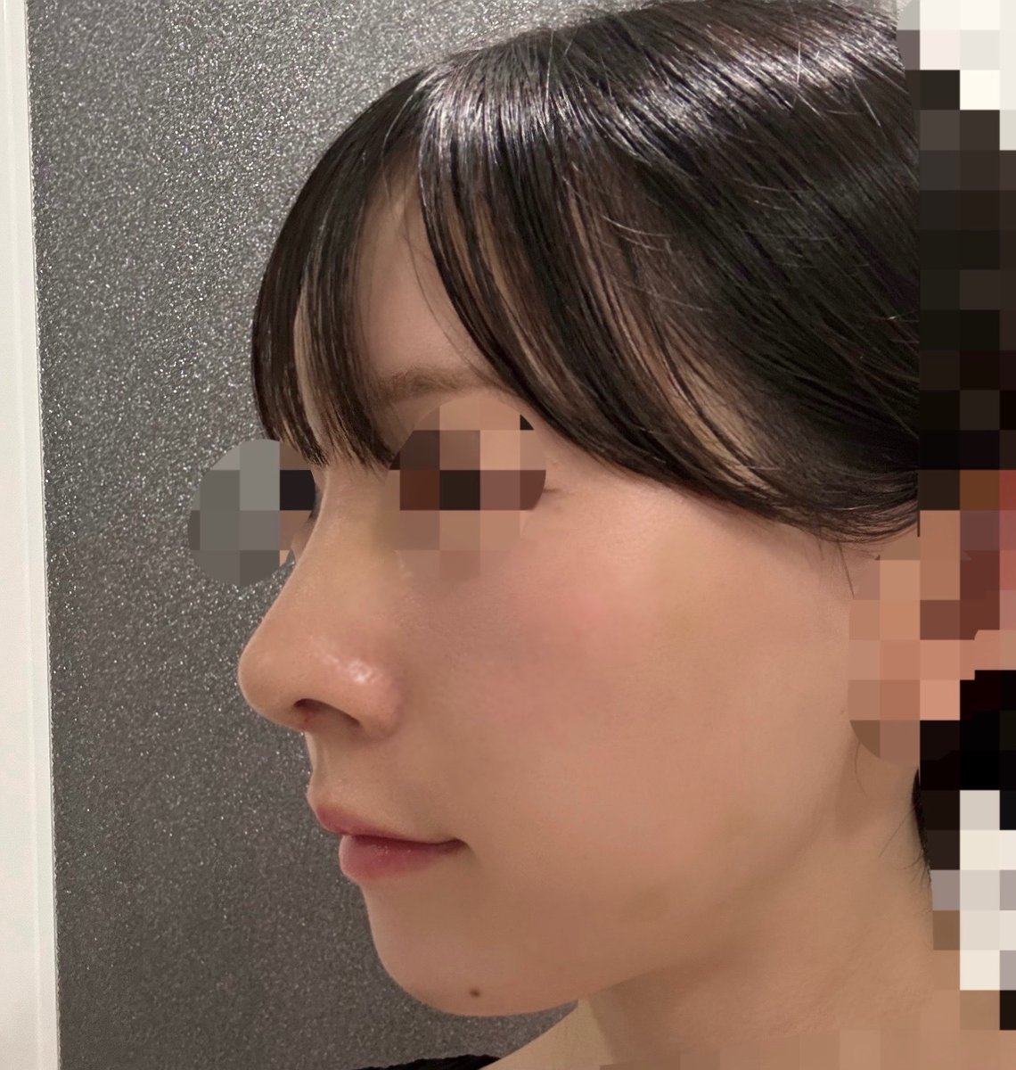 _oshiritantei_'s tweet photo. DT8日目下膨れ感ある
DT9-10日目鼻の角栓やばい、顔のむくみとれてきた https://t.co/VD3CUCvFrR