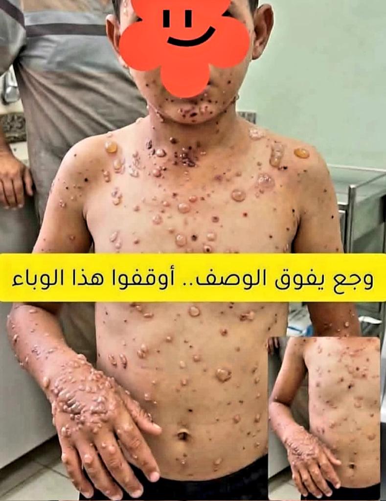 SondosMurtaja's tweet photo. The most heartbreaking image: our children in Gaz.a are suffering from chickenpox due to poor hygiene and the spread of rats. We are exhausted; our lives are difficult 😭💔 https://t.co/QDQtXjpshn
