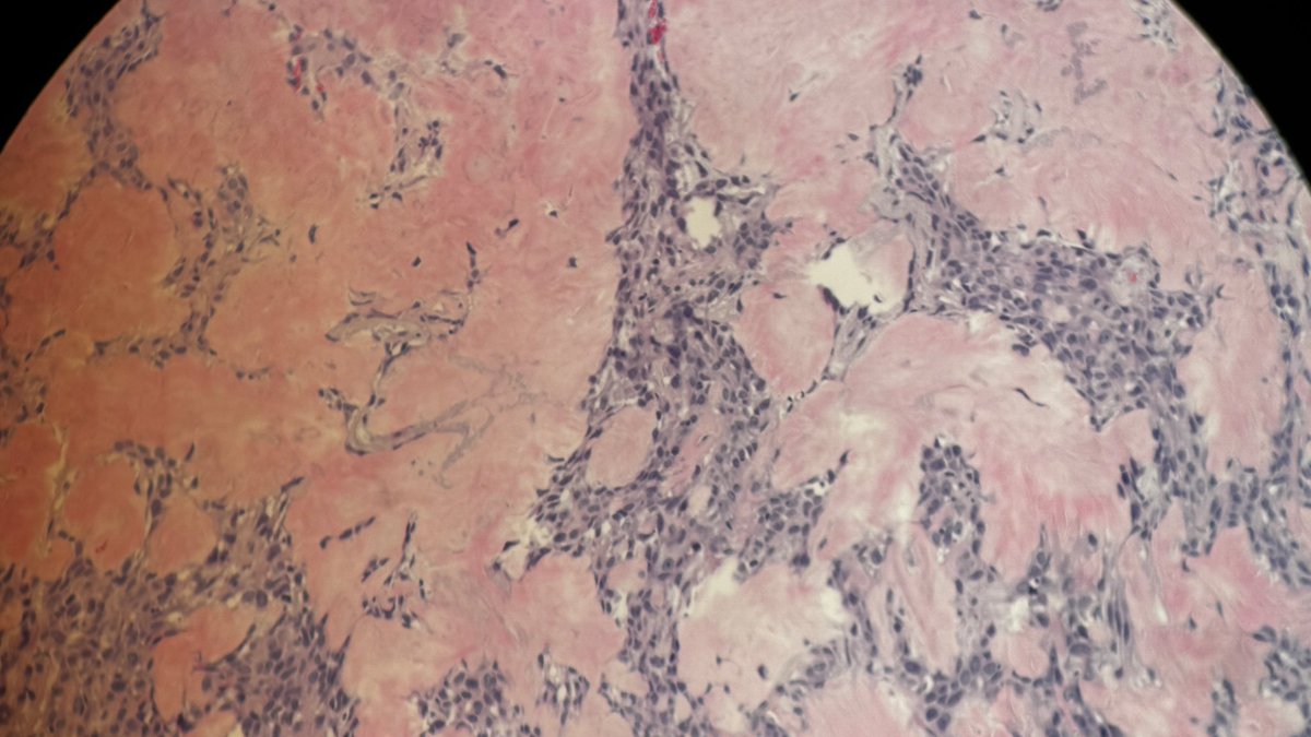 Andresangel3's tweet photo. #ENTpath #surgpath #HeadNeckPathology #SalivaryGlandTumor #salivary #pathology 55 yo man with 1.1 cm encapsulated nodule in submandibular gland. No mitosis, no necrosis, no perineural invasion. Looks to me like a cellular PA, benign mixed tumor. Your opinion please…… https://t.co/HE1wOp7NYb