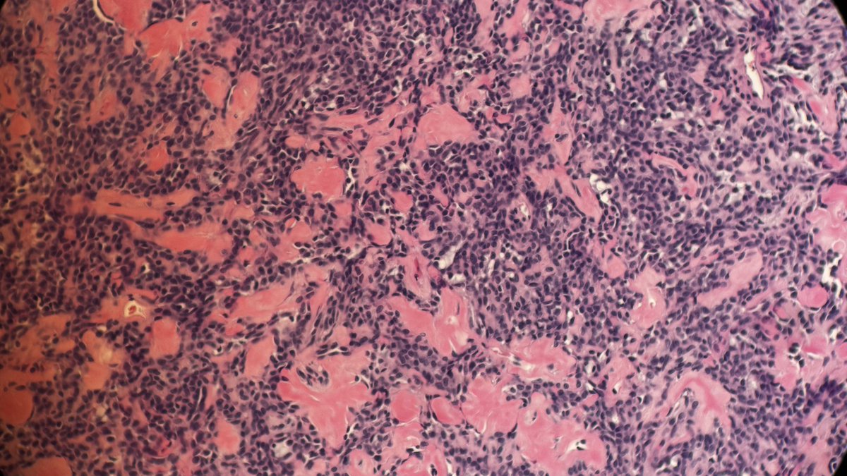 Andresangel3's tweet photo. #ENTpath #surgpath #HeadNeckPathology #SalivaryGlandTumor #salivary #pathology 55 yo man with 1.1 cm encapsulated nodule in submandibular gland. No mitosis, no necrosis, no perineural invasion. Looks to me like a cellular PA, benign mixed tumor. Your opinion please…… https://t.co/HE1wOp7NYb