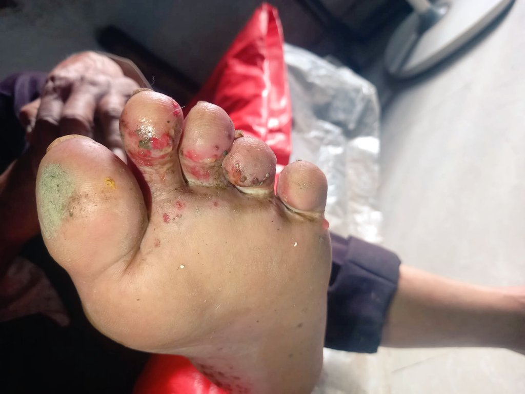InnocentlyLegal's tweet photo. @CMOMaharashtra @vvcmc_official @VasaiVirarForum due to the water logging in my house my parents who were alone as I cudnt rch them suffered with infection on their feet due to dirty water. Both are 70+, how much more should ppl suffer bcoz of govt inaction. https://t.co/EyBiELRbRU