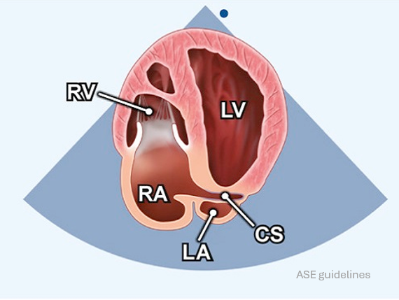NephroP's tweet photo. #echoboards prep question
Which tricuspid valve leaflets are typically seen in this view?
POLL in thread.
#POCUS https://t.co/0YuP2LuOCv