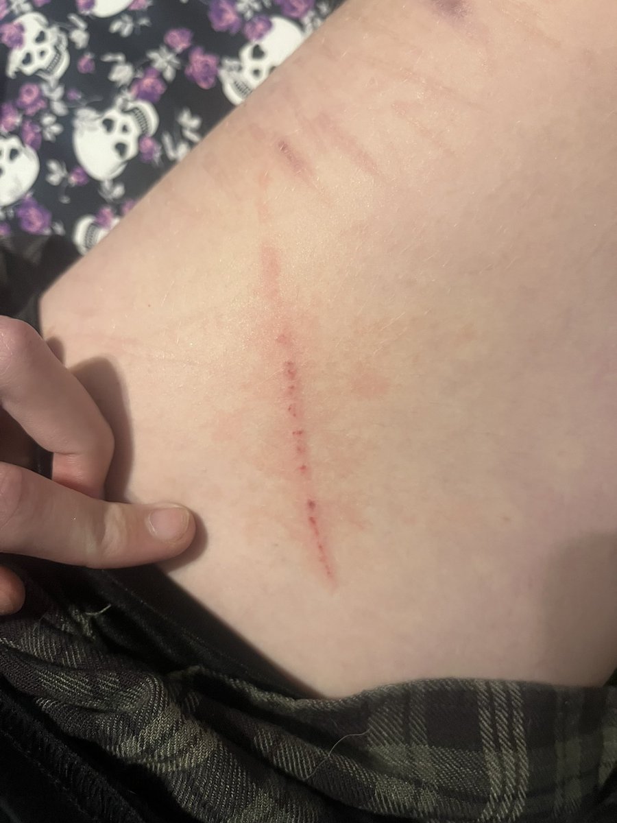 flynnstarrzz's tweet photo. the fucking dog scraped my thigh 🤬🤬🤬🤬 https://t.co/Wv90y6dJzx