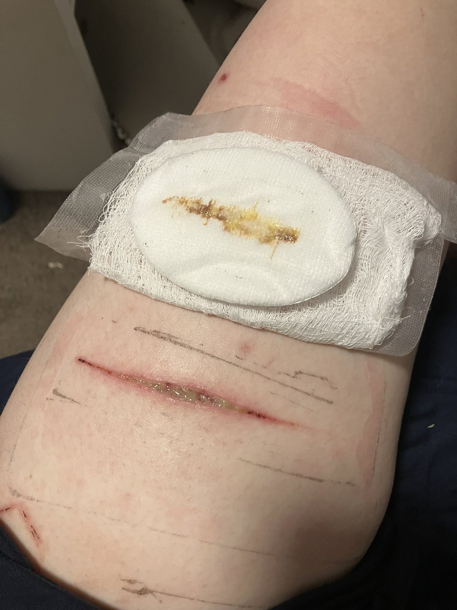 rollypollyX3's tweet photo. Oh so what (FAKE WOUND!!)

#shedtwt #slitwt #shtwt https://t.co/uaI6FmPSc1