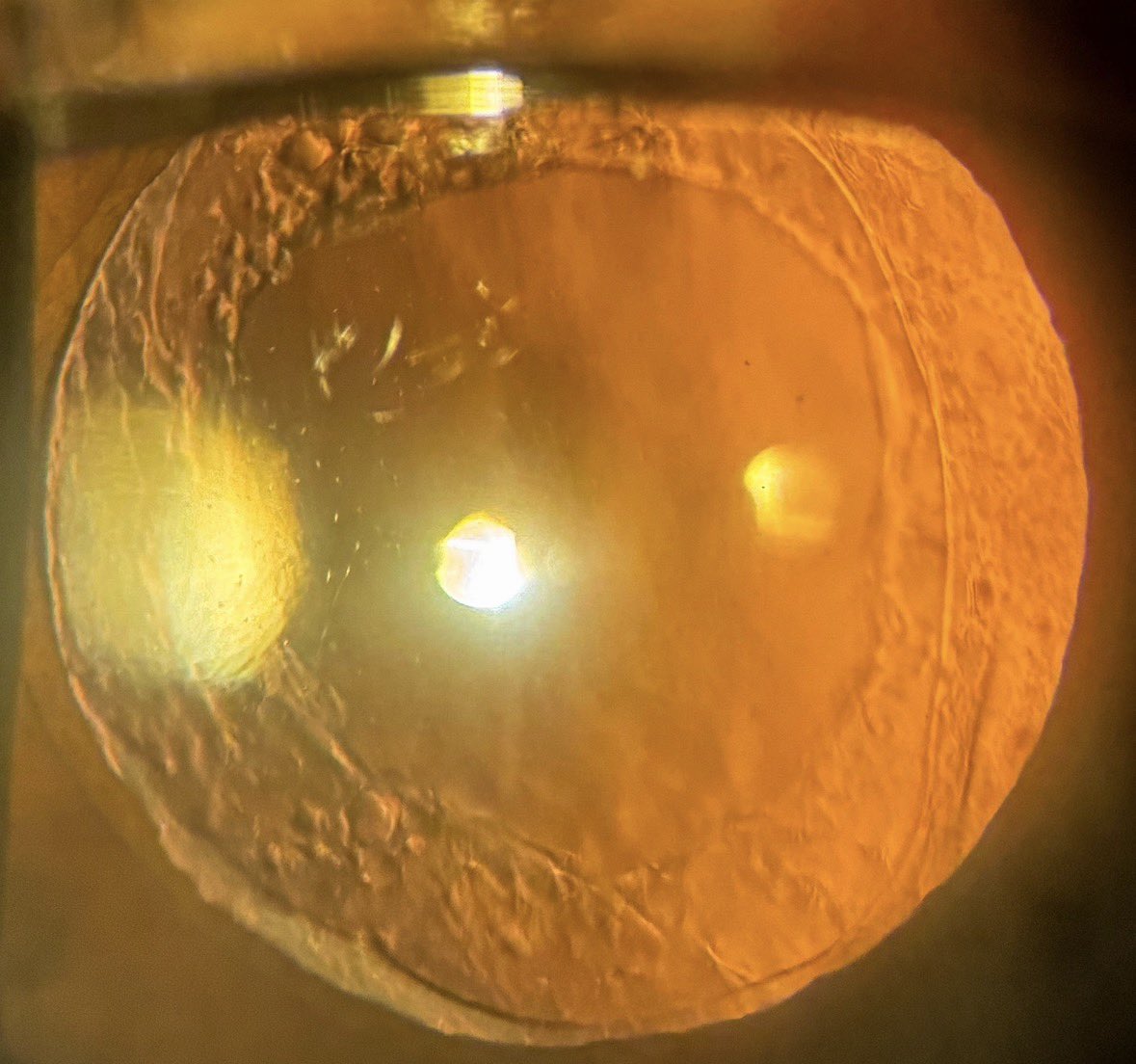 NakamuraHudson's tweet photo. 🔴🗜 Case https://t.co/1N2JwrLL49 | Retinawesome Clinic | Surgical | ✅Macular Pucker | Pre and Post Vitrectomy for Combined ERM-ILM Peel | Management: | See more on “X” Retinawesome (NakamuraHudson) and follow our YouTube Retina Channel at https://t.co/eJLrkxj9Vg
This case involves a 53‑year‑old woman who presented with a symptomatic epiretinal membrane (ERM) in the right eye, accompanied by pronounced metamorphopsia that significantly affected her daily visual function. At presentation, her best‑corrected visual acuity (BCVA) was 20/60, consistent with tractional distortion of the foveal contour.
Comprehensive preoperative imaging was obtained, including color fundus photography, wide‑field retinal imaging, and macular OCT, all of which demonstrated a dense epiretinal membrane with inner retinal wrinkling, loss of foveal contour, and tractional changes extending beyond the central macula. These preoperative images are included for comparison.
The patient underwent pars plana vitrectomy with meticulous ERM and internal limiting membrane peeling. The procedure was uneventful, and postoperative recovery progressed as expected.
By postoperative visit number 15, her BCVA improved to 20/40, with a marked reduction in metamorphopsia (actually disappeared). Postoperative retinal photographs and OCT scans — also included for comparison — demonstrate:
Restoration of the foveal contour
Resolution of tractional striae
Normalization of the inner retinal layers
Improved macular reflectivity and architecture
Together, the pre‑ and postoperative images highlight the anatomical and functional improvement achieved through surgery, illustrating the correlation between structural recovery and visual gain.