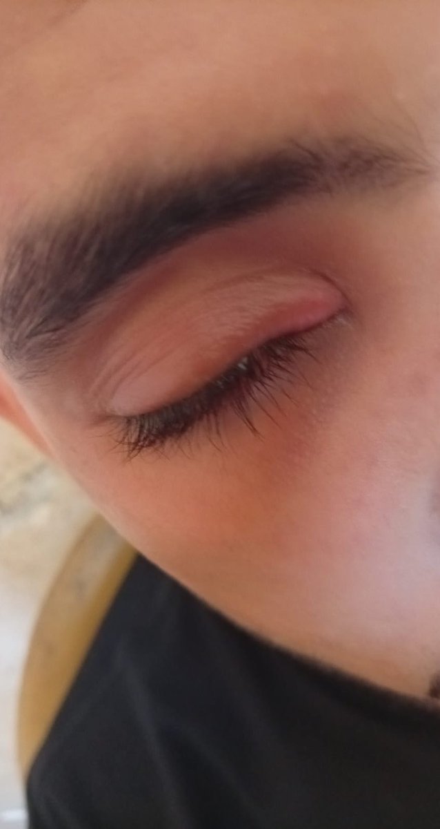 LbrahimR5516's tweet photo. My dear friends, I am suffering badly from severe eye inflammation, and I urgently need to buy an ointment that costs $30. Could anyone please help me with this? I am in very severe pain.
https://t.co/avTcgTJR9Y https://t.co/iNKz0mpXpY