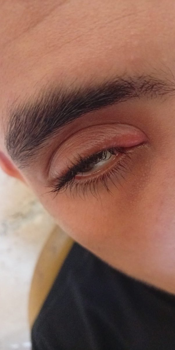 LbrahimR5516's tweet photo. My dear friends, I am suffering badly from severe eye inflammation, and I urgently need to buy an ointment that costs $30. Could anyone please help me with this? I am in very severe pain.
https://t.co/avTcgTJR9Y https://t.co/iNKz0mpXpY