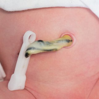 S_k061's tweet photo. Learn how to care for your newborn’s umbilical cord safely. Discover cleaning tips, signs of infection, when the cord falls off, and when to call your baby’s doctor.
https://t.co/aVO3IsenF9
#BabyCare #Parenting #NewParents #BabyHealth #InfantCare #BabyTips #BellyButtonCare https://t.co/vgwqVo0lTt