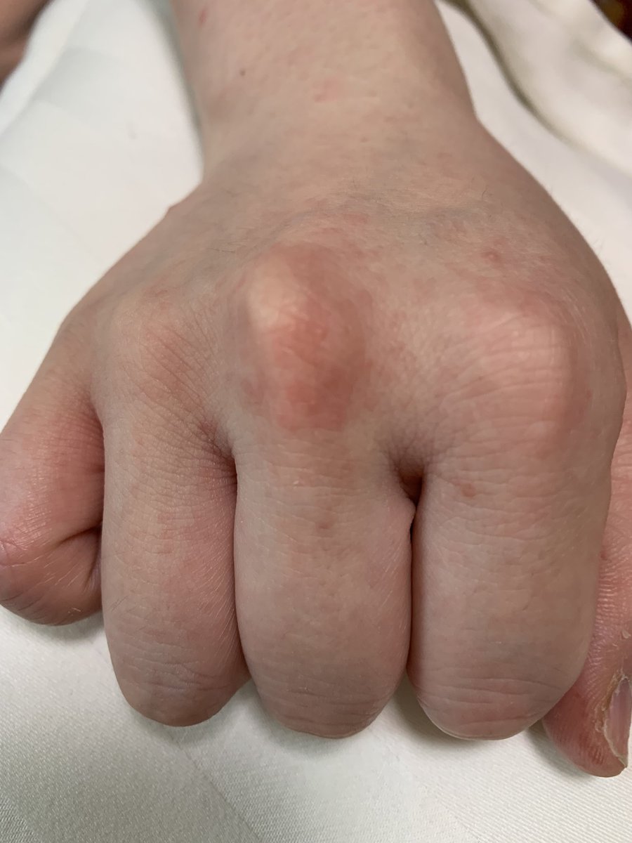 haminglove87's tweet photo. 娘いろいろ病院行って分からず、抗生剤だけもらってくる。日に日に様子がかわり。39℃の熱からはじまり、私は今それがいつだったのかきおくなし。手足口病らしい https://t.co/tPvK2OebDA