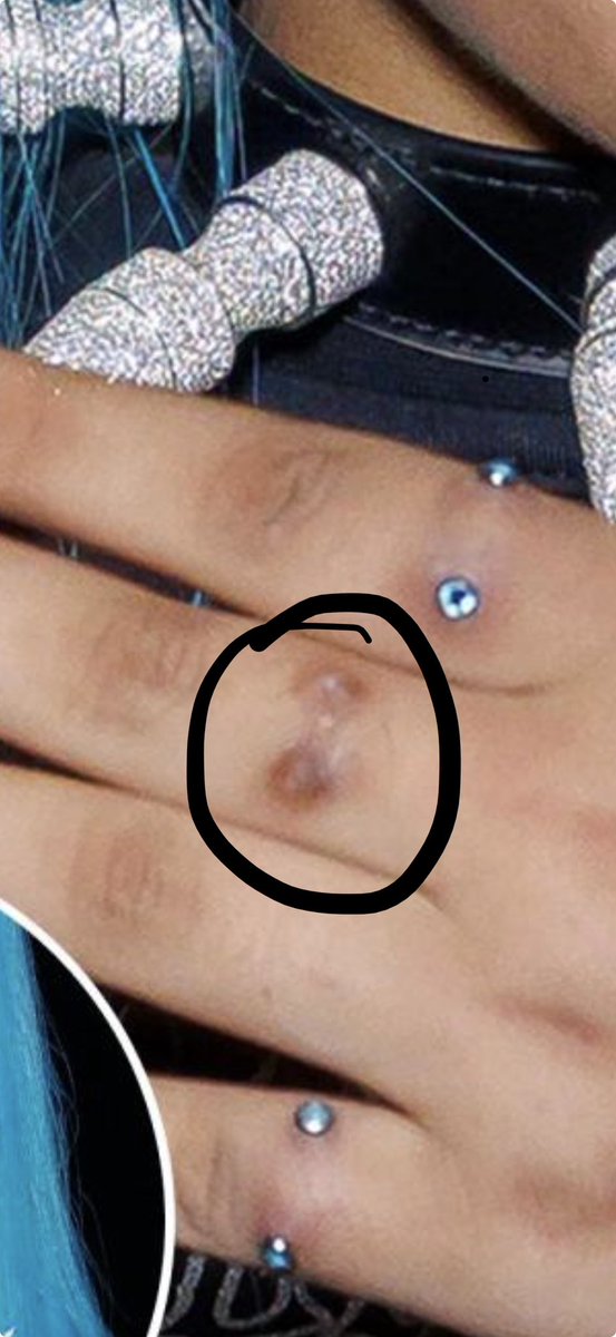 pppinkyprincess's tweet photo. @nonasboytoy @sandytaboo and this is a scar from it lmaooo https://t.co/GY8jdCfQ40
