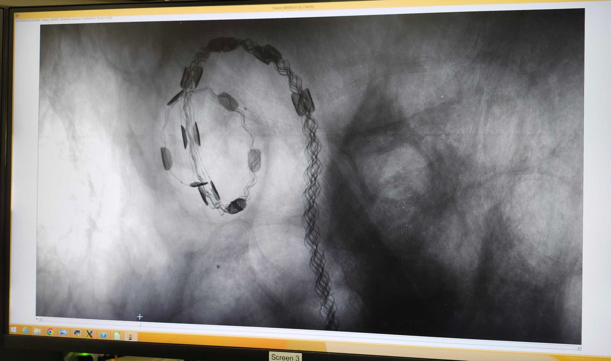 CanLightSource's tweet photo. Researchers from @westernuScience @WesternU @SchulichMedDent are developing better ways to insert #CochlearImplants for people with profound #HearingLoss, to preserve remaining hearing and improve how well the implants work. #ResearchInAction https://t.co/rItgPOcDnc https://t.co/IiwJBJQA2x