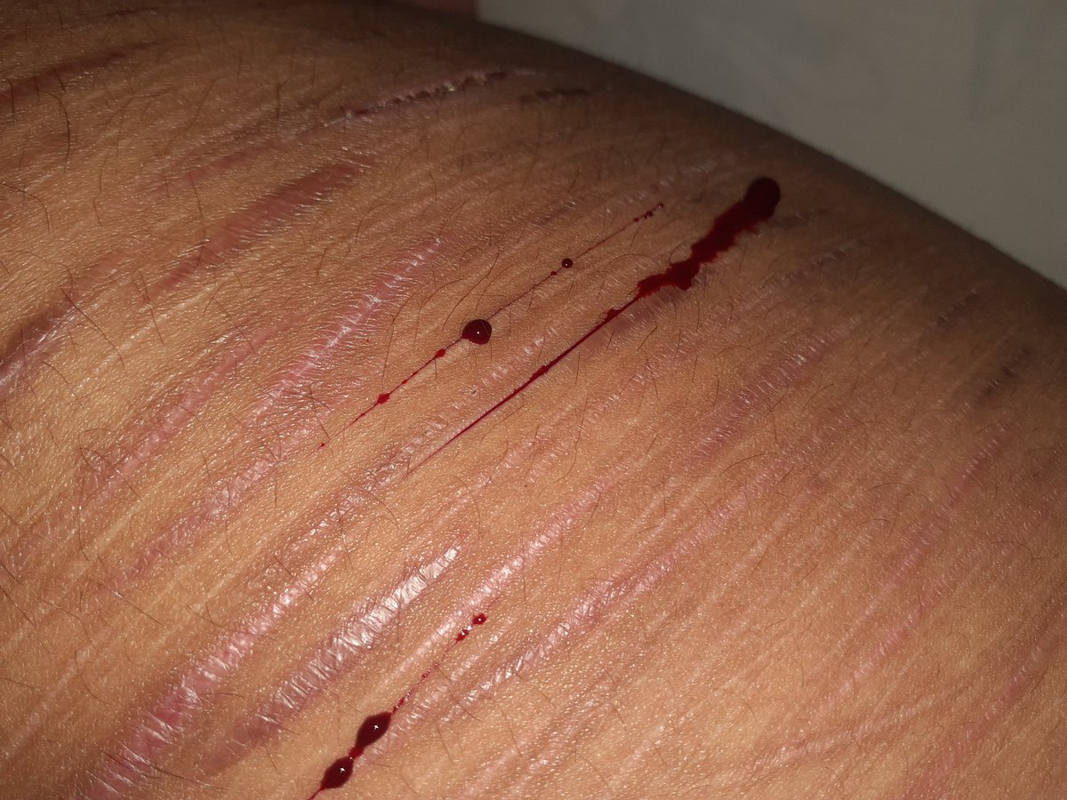 PrettyDumbSa's tweet photo. #shtwt #slittwt #cutting #selfharm #988twt #styrostwt #shtwt ♡

Finally on vacation,, Now I can finally rest and sleep properly! ^_^

( ALL fake, make-up 😛 ) https://t.co/tjLCFXXknp