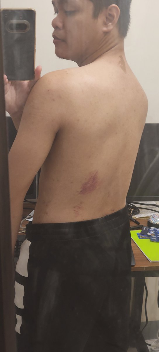 LeeRaeGaming18's tweet photo. Went to grab dinner last night, and really just moments after leaving my place, I slipped and fell down a small flight of stairs 🤣🤣🤣 thankfully just a bruise, but shit still hurts like a bitch https://t.co/D7qoytNowa
