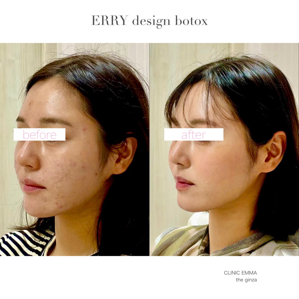 CLINIC_EMMA's tweet photo. アーモンドアイにきれいな鼻と唇、パーツは完璧✨なのに今ひとつ可愛さが足りない？🤔
輪郭美人ボトックスでフレームを整えれば、本来の美しさが一気に覚醒😆フェイスラインもコンパクトになり、真顔の重心まで上がります💖 https://t.co/NniY9QR3Ag
