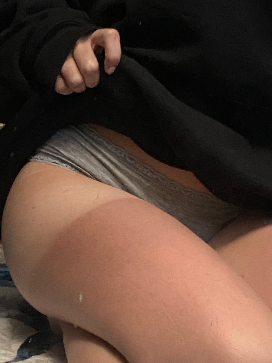 devouringintent's tweet photo. sun burn update 😖 i hate shorts https://t.co/dj9VGlMkRa