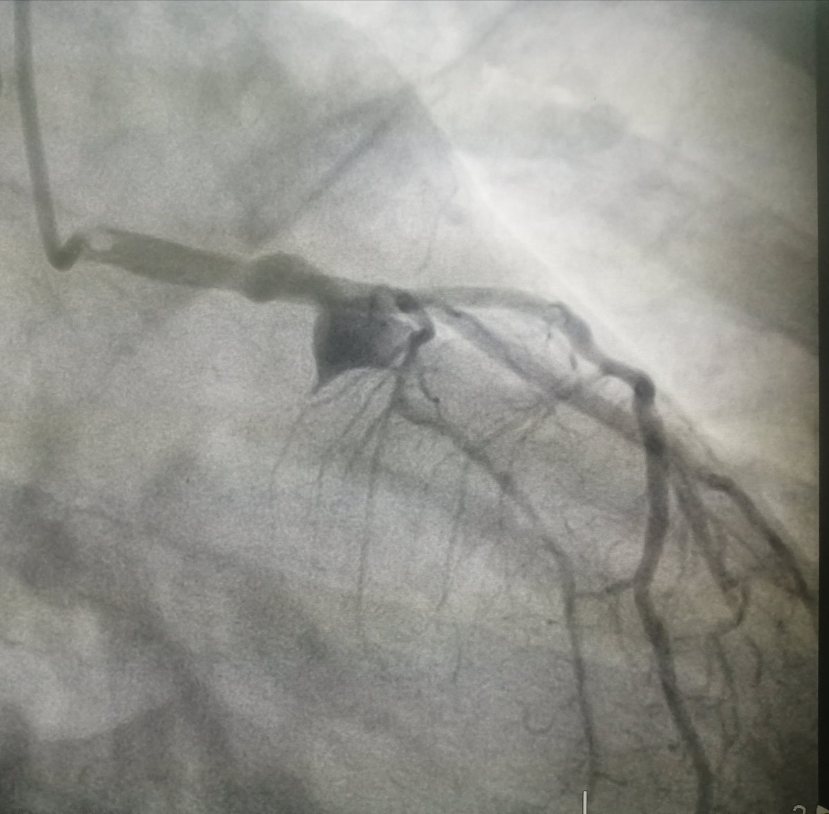 mohammed_98j's tweet photo. Pt was admitted to CCU &amp; DCA done which showed a proximal LCX aneurysmal dilatation followed by totally occluded vessel. https://t.co/FfGJMHSW3m