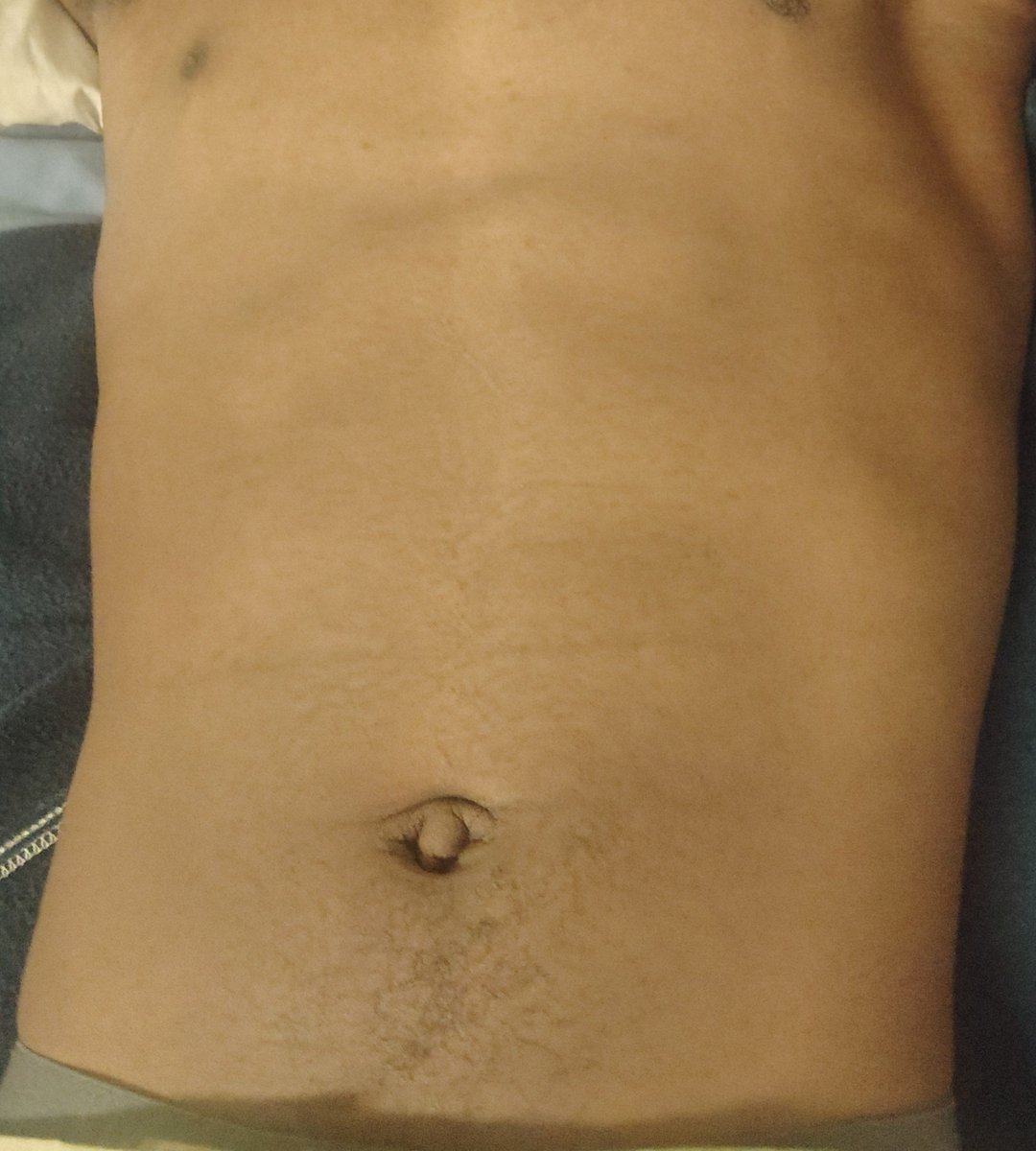 TerrorUpholds's tweet photo. Prolly deleting this in the morning. But can't post on pub and it's a genuine question 

Chat is this normal looks? Like I'm pretty underweight, that I know but like... I feel like underweight should probably look different, no? https://t.co/oAeo1tDoa7