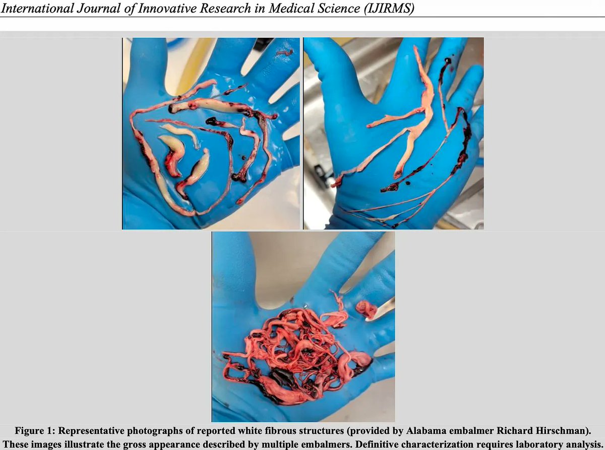VirusFighterVi1's tweet photo. CALAMARI CLOTS: A NEW, BLOOD-BORNE SYSTEMIC AMYLOIDOSIS https://t.co/JCGGP3u3Ky 
The study analyzes unusual white, rubbery, fibrous structures (often called “embalmer’s white clots” or “anomalous intravascular fibrous casts”) found in blood vessels. These have been observed in deceased individuals by embalmers since around spring 2021 and, in some cases, in living patients by vascular surgeons. At first glance they resemble blood clots, but the paper concludes they are structurally different.