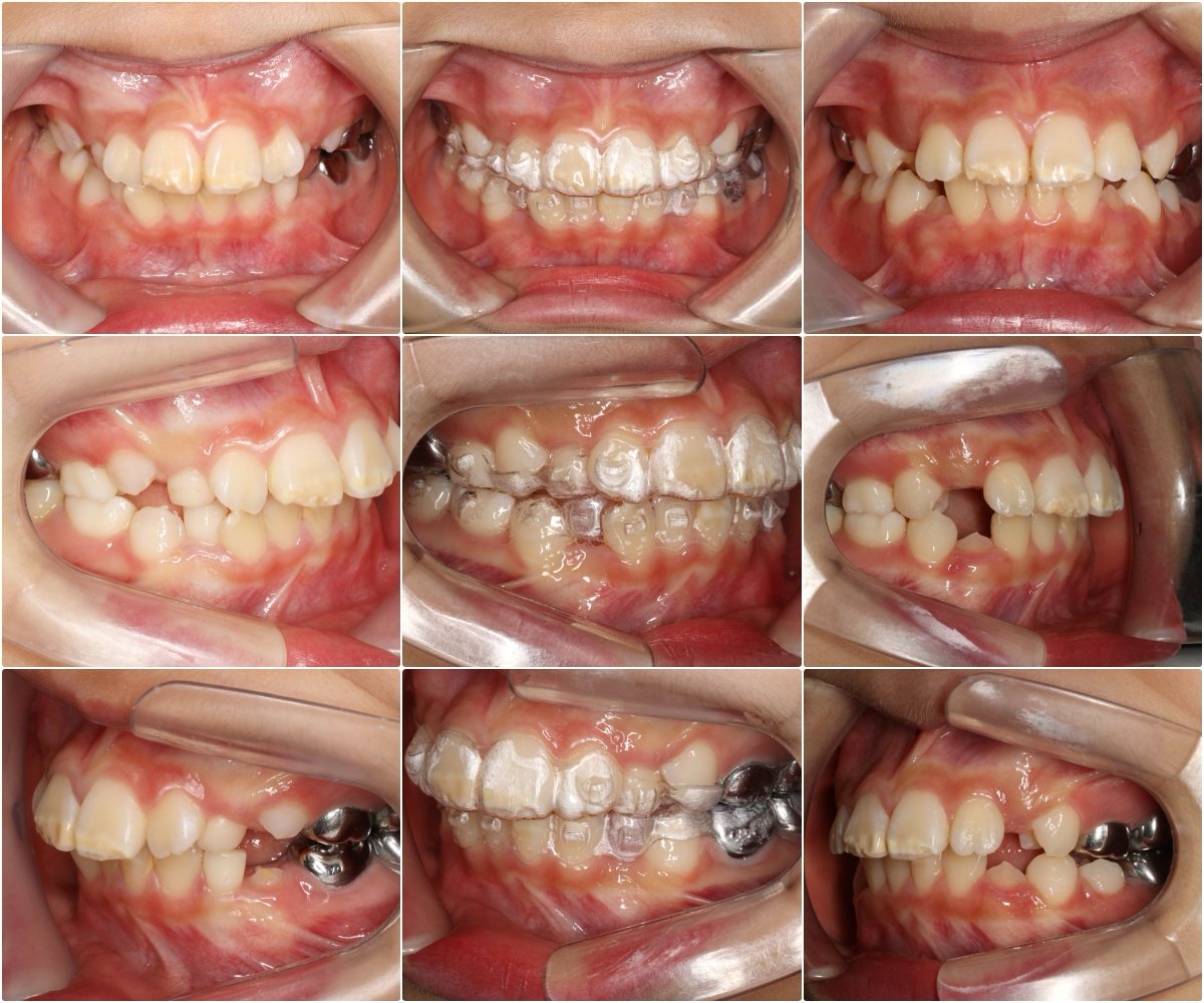 hypeortho's tweet photo. 아이 ClinCheck을 성인처럼 계획하면

인비절라인 퍼스트 최대 실수입니다.

소아 ClinCheck은 교정이 아니라 예측 게임.

#인비절라인 #인비절라인퍼스트 #angelaligner #앤젤얼라이너 https://t.co/D5Ap4JFK4L