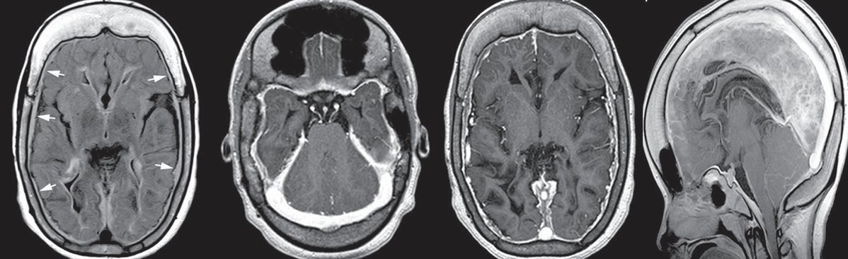 spinacademics's tweet photo. This week's SPIN-POV: Along with slit ventricles and subdural collections, chronic CSF overdrainage after shunt surgery can produce imaging features of intracranial hypotension. Recognizing this constellation is important, as severe cases may require shunt revision. https://t.co/UOse2K6WAx