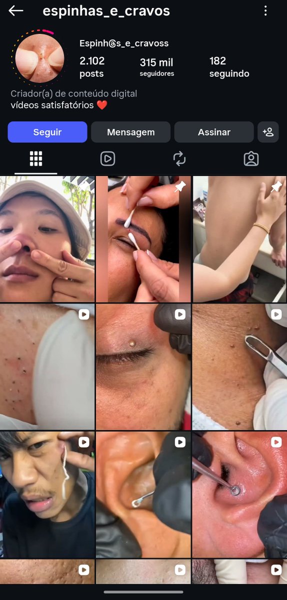 Mecibrasileiro's tweet photo. Tem uma pagina no instagram que é literalmente videos de pessoas espremendo espinhas e cravos e o mais bizarro 313mil pessoas seguem 🫣 https://t.co/ABNpW9SG9U