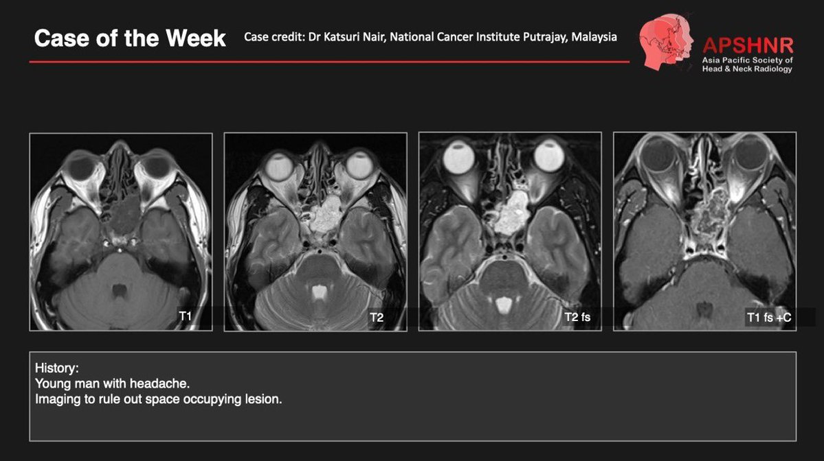 APSHNRORG's tweet photo. APSHNR Case of the Week – Week 2-Answer Revealed (Swipe to reveal ➡️)

Thank you to everyone who participated in our Second APSHNR Case of the Week! We enjoyed seeing your differential diagnoses and the discussion.

#APSHNR #CaseOfTheWeek #HeadAndNeckRadiology https://t.co/I0UU5Pp4hk