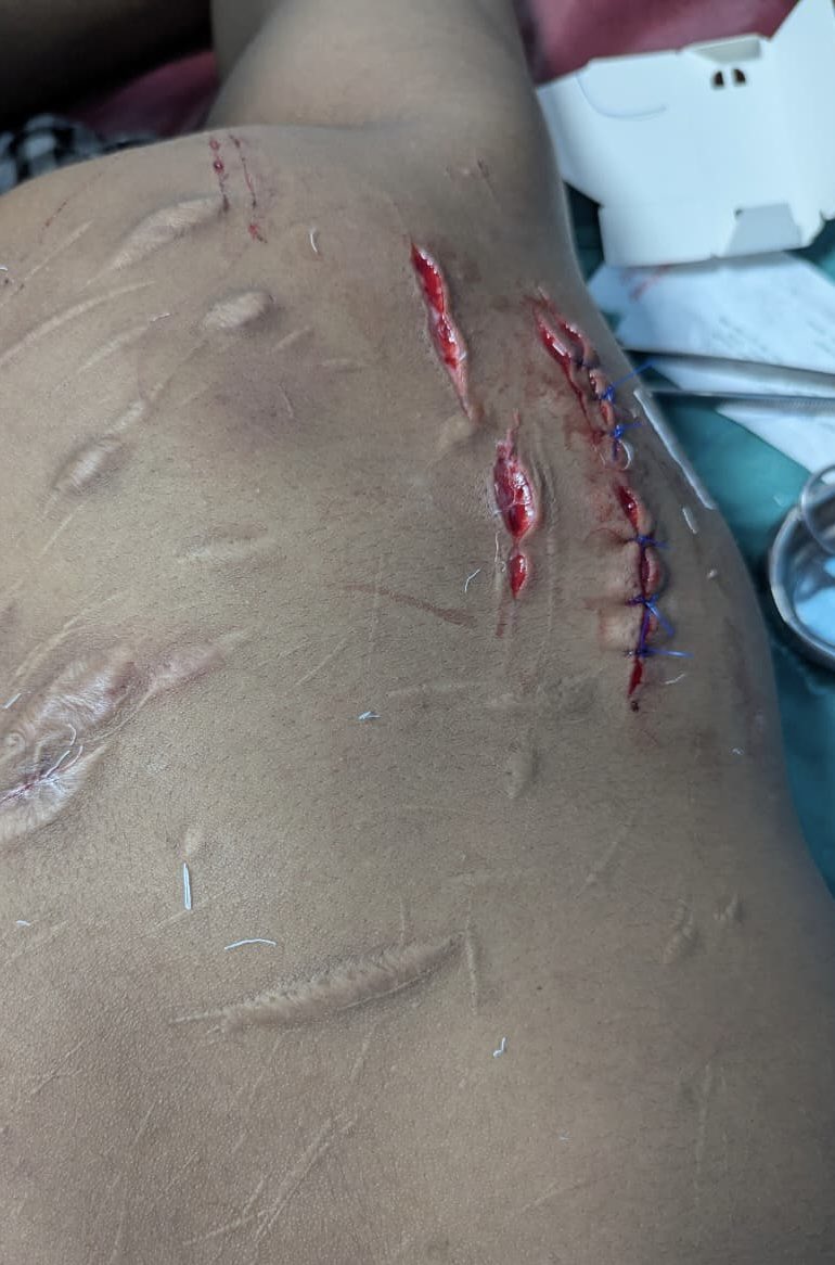 mimosa_862's tweet photo. 2-week electives in General Surgery and Surgical Oncology ✅ 
Learned suturing and observed procedures including laparoscopic cholecystectomy, total thyroidectomy, hernia repair, modified radical mastectomy (MRM), wound dressing, and vacuum assisted wound therapy (VAC dressing) https://t.co/sEpgFqR2UQ