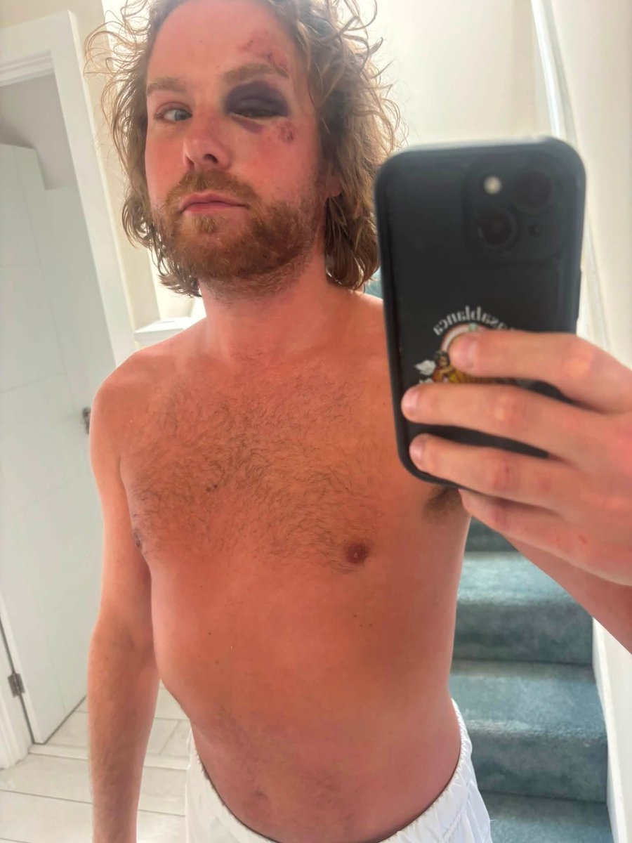 sotontimes's tweet photo. 🔺Local suffers vicious attack from men speaking Arabic in Bournemouth: A well-known DJ has spoken out after alleging he was violently attacked and robbed while waiting for a bus home in the town centre.

Tomsy Shrewsbury, who says he has worked as a DJ in the town’s bars and restaurants for the past 13 years, shared photographs of his injuries and says he was assaulted by four men before being robbed of his wallet and cash. 

According to Tomsy, the group shouted at him in Arabic before punching and kicking him, leaving him with serious facial injuries before fleeing in the direction of a well known hotel. Posting on Facebook: “Last Wednesday I was waiting for a bus home (before the England V Congo game finished). 

Out of nowhere, 4 men started shouting at me (Arabic), and hit me 3 times in the face. Then kicked me when I was on the floor, took my wallet, and cash.

Apparently I’m lucky to still have my eyesight.

Luckily, a lovely group saw this, chased them, called police and ambulance.

Still waiting to hear from the police… 10 days later - still nothing…

These guys were laughing, spitting on me, and fled towards a certain Hotel.”

Tomsy says he has now fully recovered but decided to speak publicly because he believes the incident highlights growing concerns about public safety in the town. He also says he has not yet received an update from police more than a week after the alleged attack.

In his post, he stressed that he has “respect for people from all backgrounds, ethnicities, religions and sexuality,” but said he believes “things need to change.”

The post has been widely shared on social media, with many local residents expressing support and wishing him well.