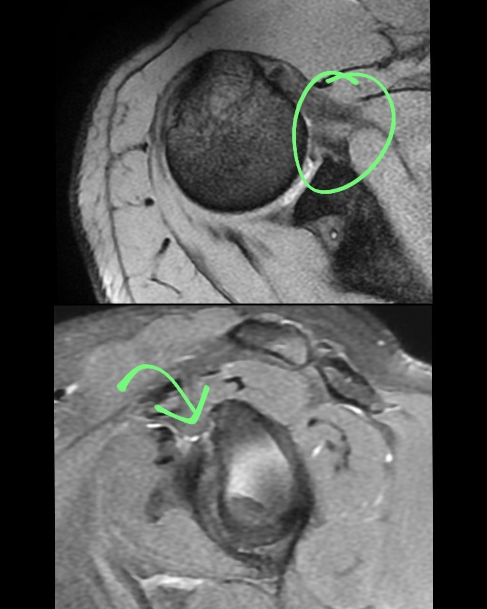 StuckOnASlice's tweet photo. 32 M- Shoulder pain since 1 month. Diagnosis ?
#radtwitter #mri #mskradiology #radiology https://t.co/8lc9n7QeMt
