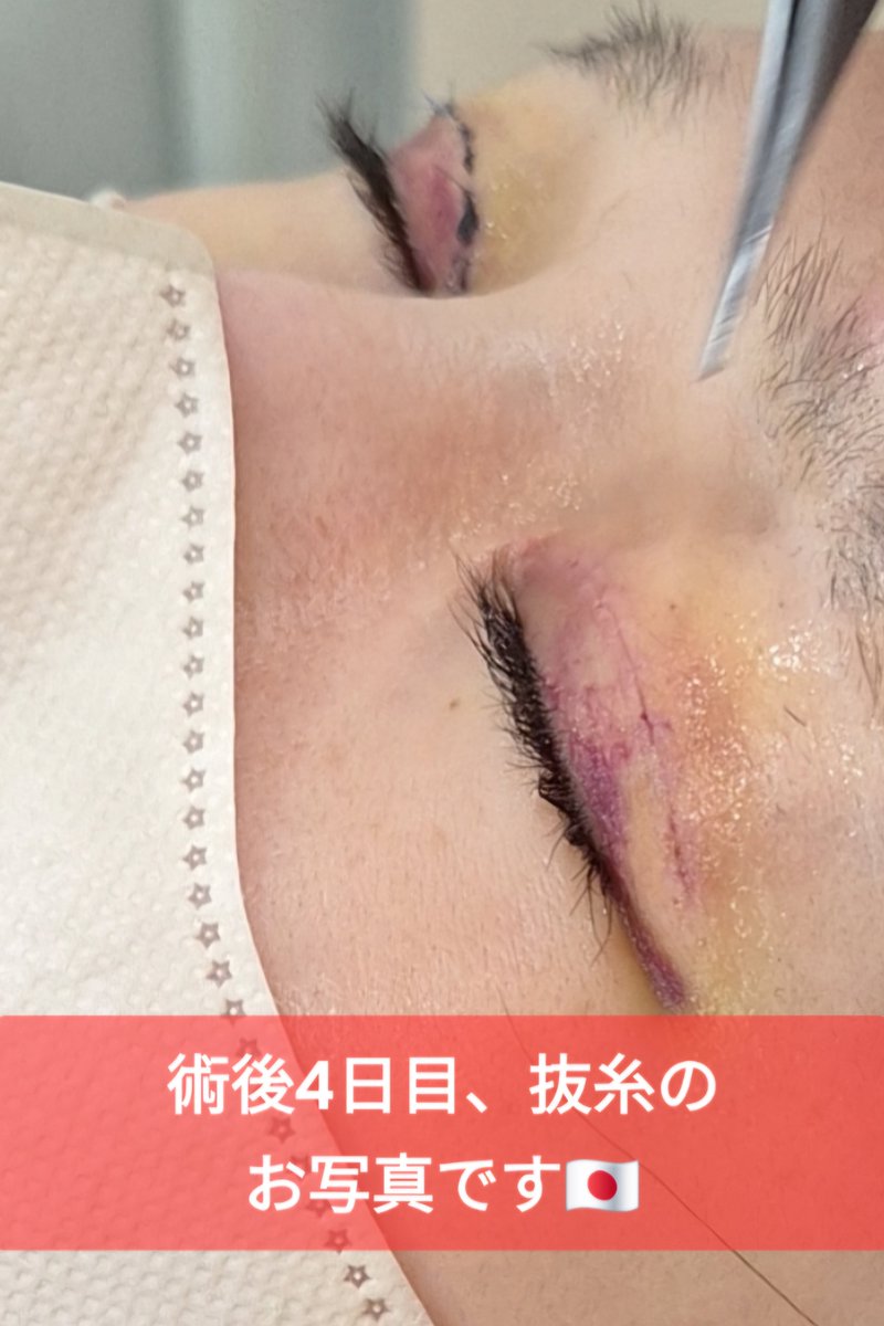 dr_ahn_ps's tweet photo. 全切開二重手術後のアザや腫れ、気になると思います。腫れは皮膚のタイプや手術歴、出血の量によっても異なります。大きい腫れは約2週間ほどで段々落ち着いてきます❗

二重のお悩みは、25年以上の目専門医ドクターアン👨‍⚕️へ！

📩 LINEで無料カウセ → https://t.co/Mg4CdsMM0V

#二重修正  #眼瞼下垂 https://t.co/YqLNcs5pPk