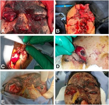 bypass67622's tweet photo. @azo2zbra @Jvnior 2) immediate vicinity of the shooting. You haven’t explained why his shirt wasn’t damaged by the explosive device. Why was his skin not charred from the supposed detonation? This is what it actually looks like when an explosive device goes off near someone’s face. ⬇️ https://t.co/5HVGwMHqys