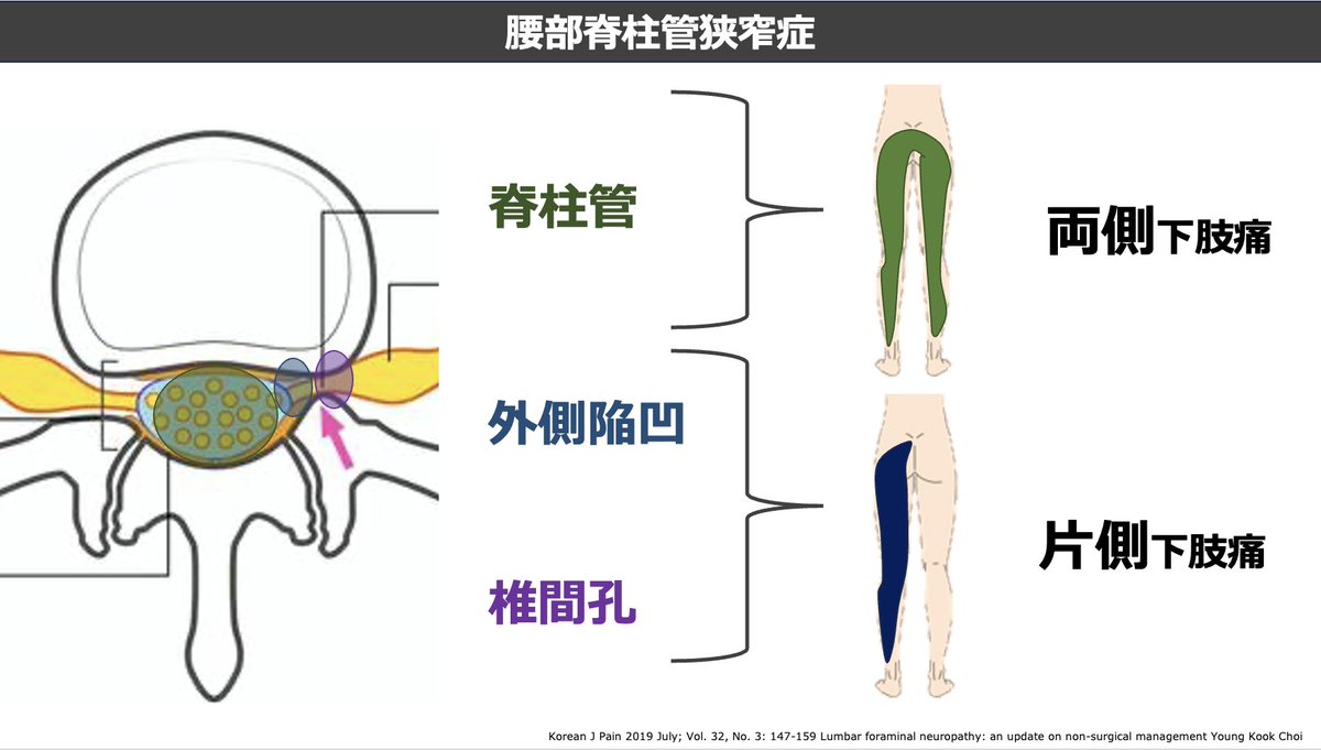 mori_pt_gbc's tweet photo. 腰部脊柱管狭窄症における病態知識、症状、疼痛部位、所見の特徴についてまとめました
臨床の一助になれば幸いです。           

セミナー参加はこちらから    
https://t.co/m6jgBd9tY4 https://t.co/Coi6Uhf8ol