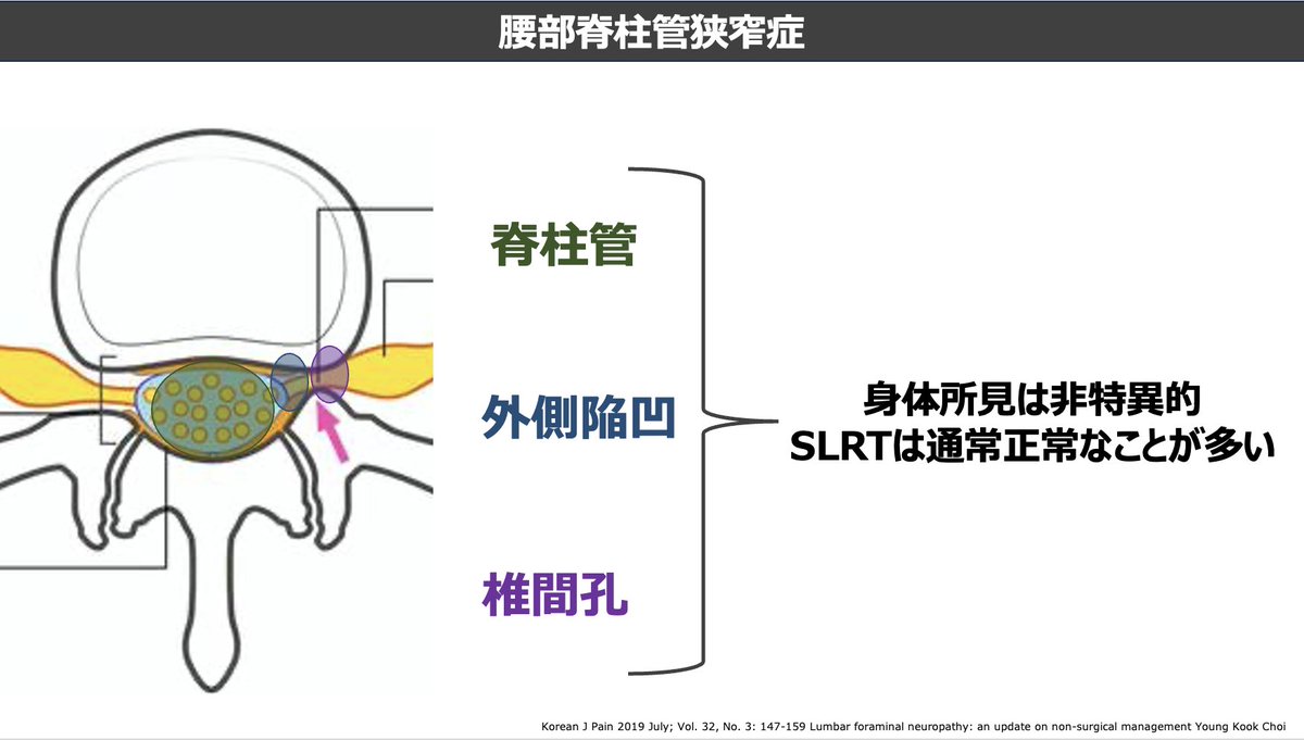 mori_pt_gbc's tweet photo. 腰部脊柱管狭窄症における病態知識、症状、疼痛部位、所見の特徴についてまとめました
臨床の一助になれば幸いです。           

セミナー参加はこちらから    
https://t.co/m6jgBd9tY4 https://t.co/Coi6Uhf8ol