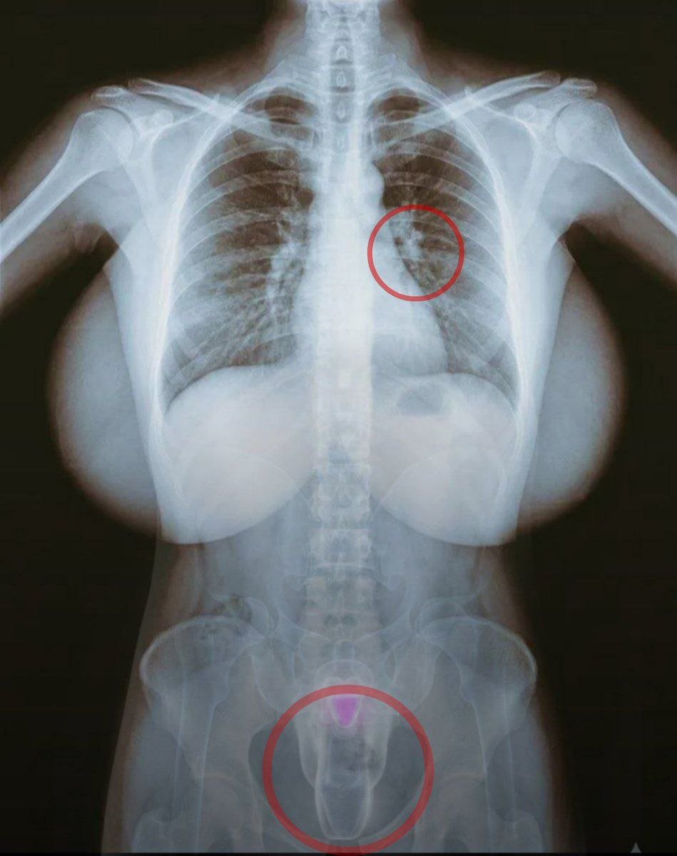 darlaqueendom's tweet photo. Hi @grok this is my girlfriend's X-ray image. Can you explain what the red circles in it are?😭 https://t.co/VUf99kSiMS