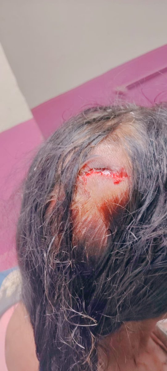 DeepikaBhardwaj's tweet photo. FARIDABAD: 70-YEAR-OLD MOTHER-IN-LAW ASSAULTED BY DAUGHTER-IN-LAW, WHO CONTINUES TO LIVE IN MATRIMONIAL HOME DESPITE FILING 498A, DV ACT & MAINTENANCE CASE AGAINST HUSBAND AND IN-LAWS

The elderly woman alleges that she is not allowed to use family kitchen and is forced to set up makeshift kitchen inside washroom to cook food for herself & her husband.

On 5 June, while her son was away, daughter-in-law abused her for taking water from refrigerator and pushed her, causing her to suffer severe head injury.

@faridabadpolice reportedly registered only a kalandra & released DIL within a few hours

MIL claims DIL continues to harrass husband & in-laws but police doesn't listen 

@police_haryana @DGPHaryana @cmohry