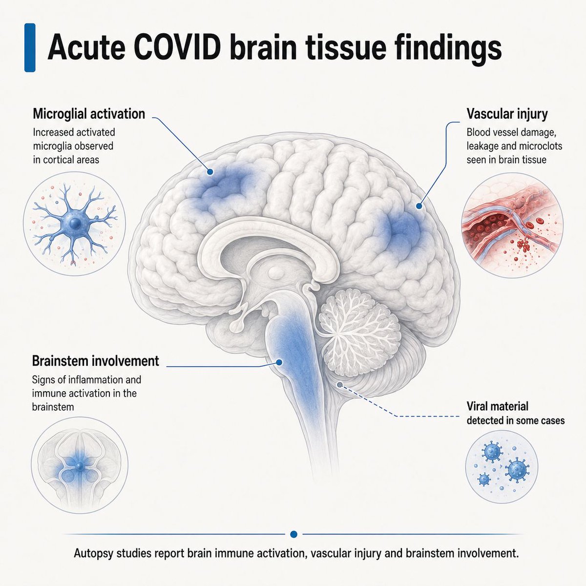 JackHadfield14's tweet photo. COVID is often described as a respiratory infection, but acute and fatal COVID brain autopsy studies show it can affect the brain. Findings include viral RNA in some brain tissue, brainstem inflammation, microglial activation and vascular injury. Let's break it down. https://t.co/rIedZq8sdx