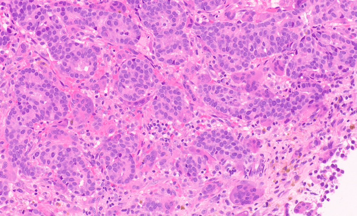 Gowri_passionP's tweet photo. Invasive Mammary Carcinoma with osteoclast like giant cells https://t.co/KBBwQhreWk