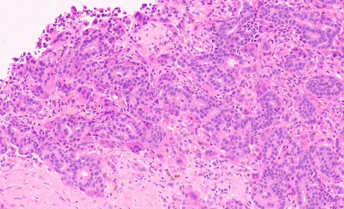 Gowri_passionP's tweet photo. Invasive Mammary Carcinoma with osteoclast like giant cells https://t.co/KBBwQhreWk