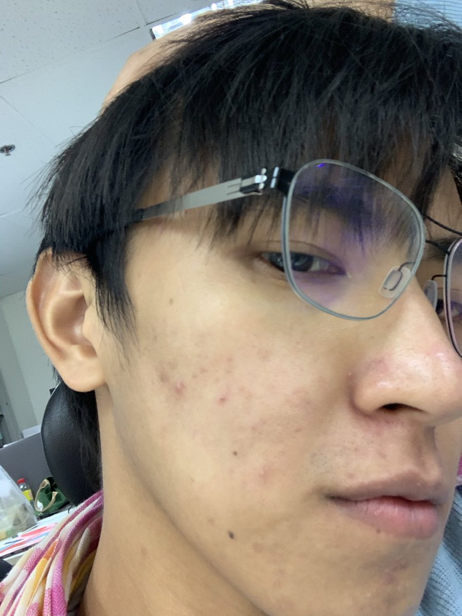 NtrioCK's tweet photo. จากรูปแรก 2019 จนถึงปัจจุบัน
เริ่มหันมาดูแลตัวเอง
- ออกกำลังกาย อย่างน้อย 5 ชม. ต่อสัปดาห์ (เพราะต้องการเพิ่มน้ำหนัก)
- ทาครีม ทุกวัน เช้า - ก่อนนอน
- หัตการมีทำเลเซอร์ Q-Switch  2 เดือนครั้ง

หลักกาารคือทำจนชิน ทำจนเป็นนิสัย

ตอนนี้คิดว่าต้องเริ่มหา Botox บ้างแล้ว ยังไม่เคยฉีดใครมีคลินิกที่ไว้ใจแนะนำได้ครับ