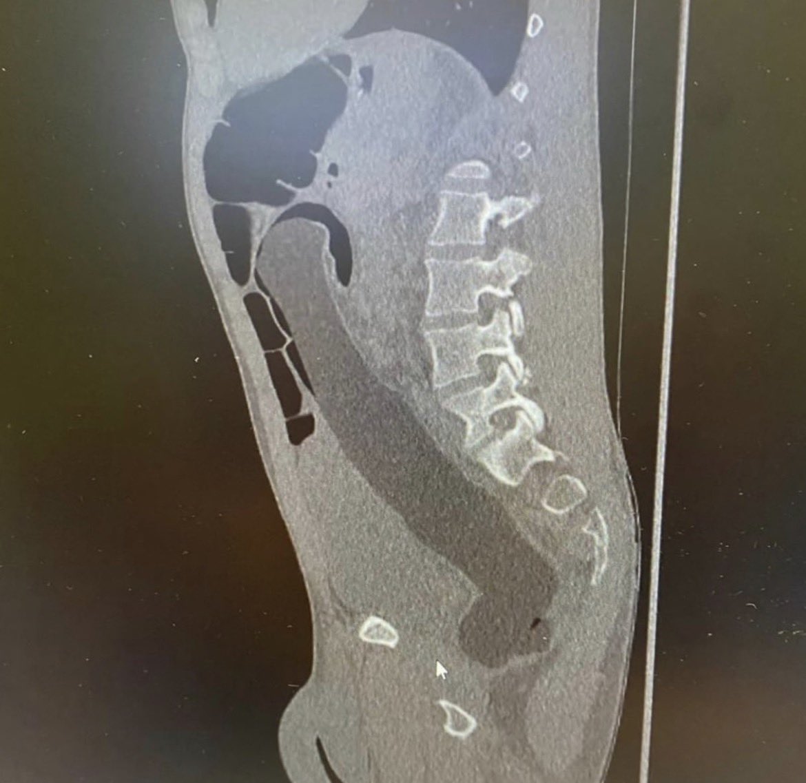 DrAbbotJack's tweet photo. Patient thought we won’t address the elephant in the room . 

Today’s foreign body; https://t.co/I39BJXKyiX